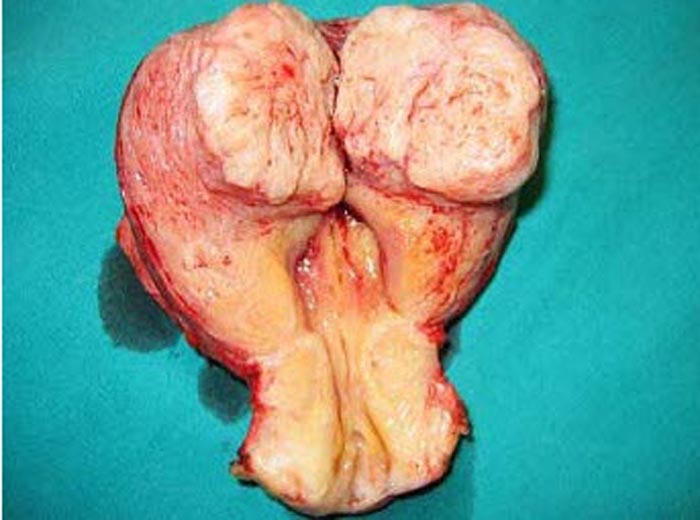 子宫肌瘤图片 真实图片