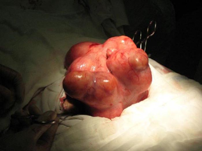 50岁子宫肌瘤10公分图片