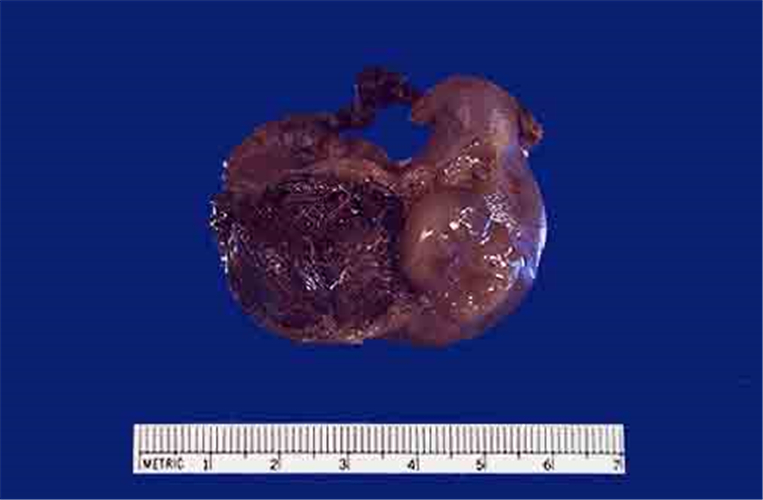 切除的输卵管宫外孕图片