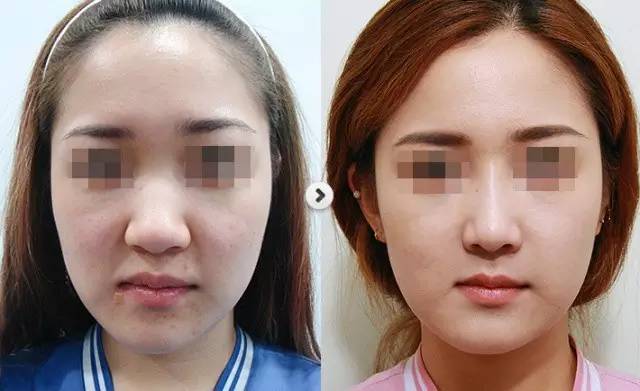 术后5-7日后拆线 不影响正常工作生活   五,鼻翼缩小手术术前术后注意