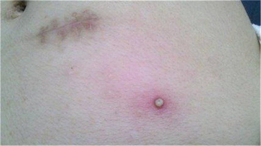 脂肪瘤前期症状图片图片
