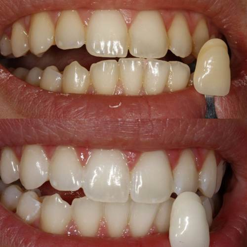 四环素牙美白后图片