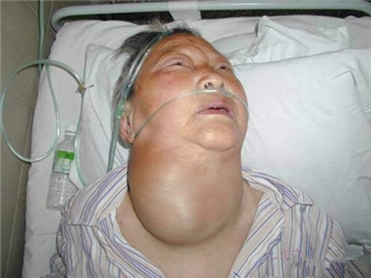 甲亢图片_甲亢症状表现图片大全_有来医生