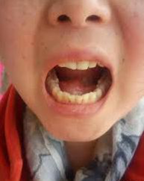 儿童舌下腺囊肿图片