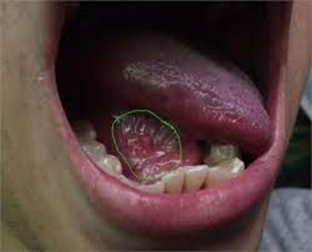 舌头下面囊肿图片图片