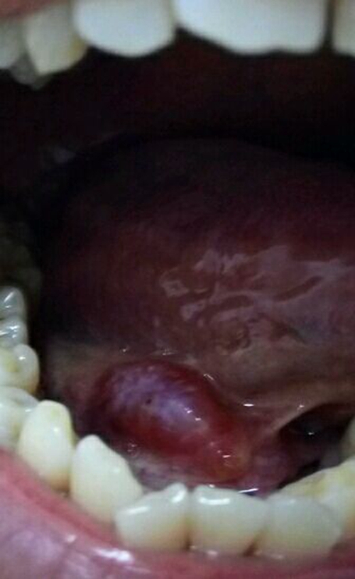 舌下腺红肿图片