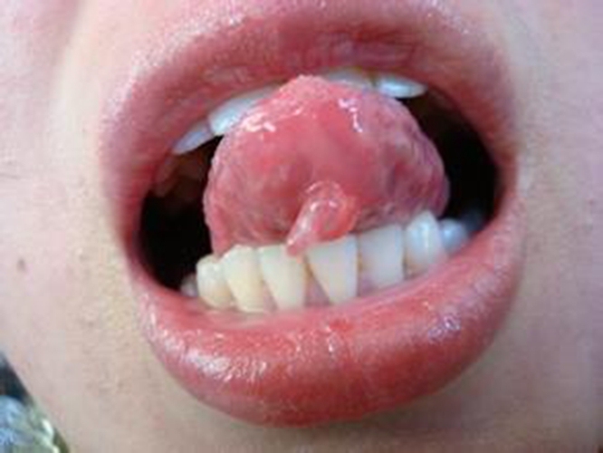 舌下腺囊肿大图片图片