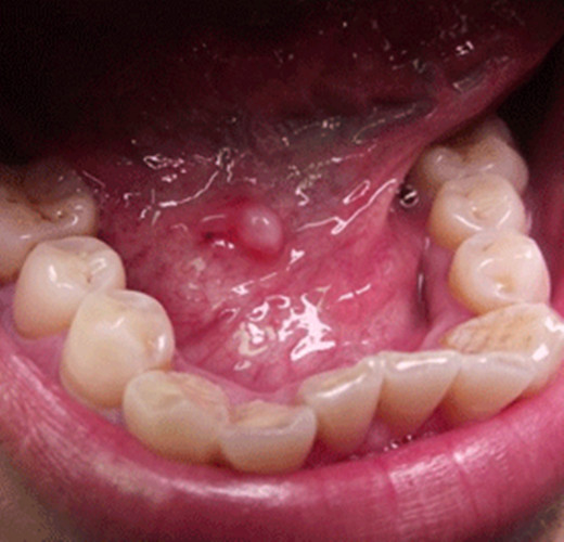 舌下腺肿瘤图片真人图片