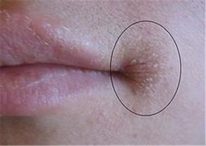 白塞氏病图片_白塞氏病症状表现图片大全_有来医生