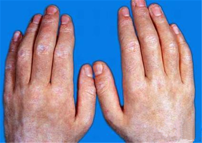 白塞病双手白斑图片