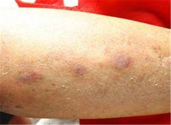 白塞病手臂症状图片