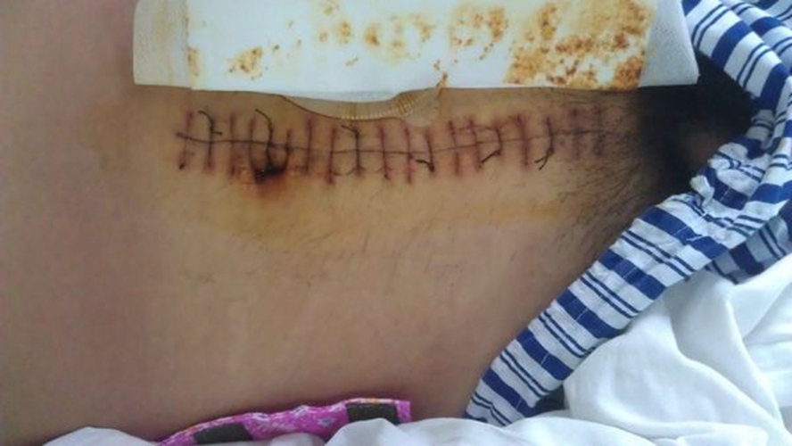 腹腔镜手术直肠癌中期图片