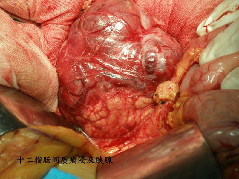 肠肿瘤手术的图片