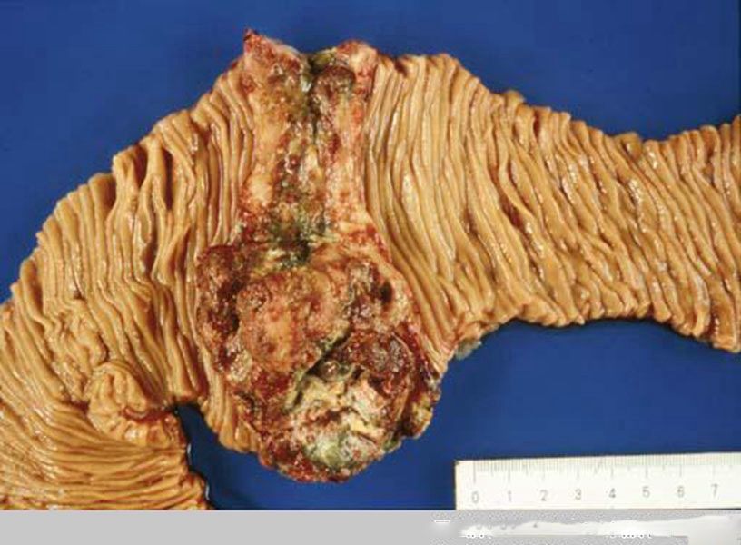十二指肠肠肿瘤过程图片