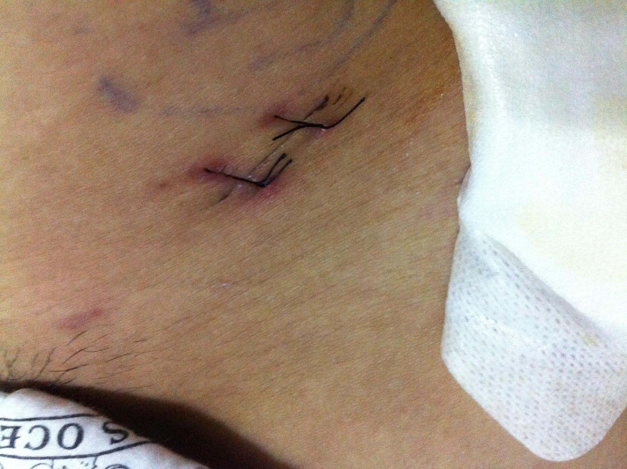 微创手术伤口真实图片图片