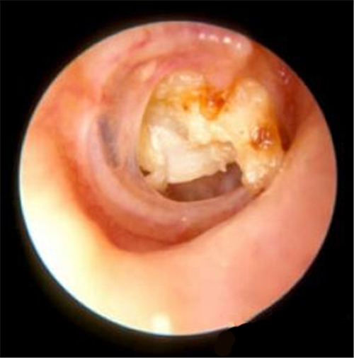中耳炎耳膜充血图片图片