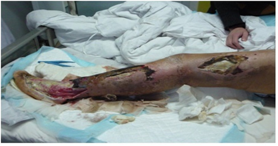 非常严重的糖尿病足图片