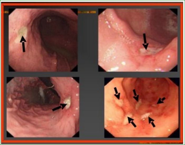 急性胃十二指肠溃疡穿孔图片