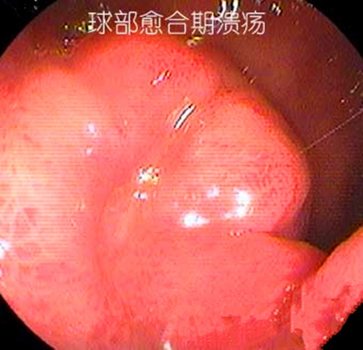 十二指肠溃疡球部愈合期图片