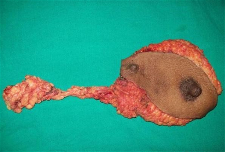 乳腺癌取出来的图片图片