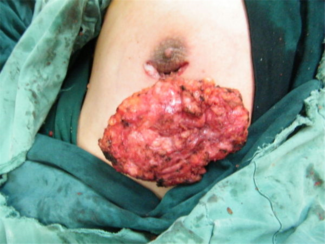 乳腺纤维瘤真人图片