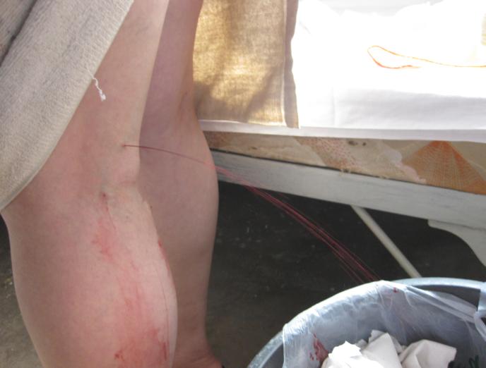 下肢静脉曲张进行放血图片