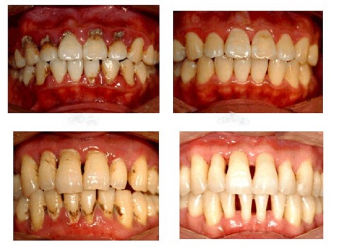 牙周炎图片_牙周炎症状表现图片大全_有来医生