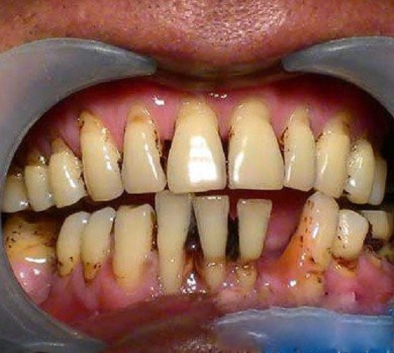 牙周炎是什么症状图片