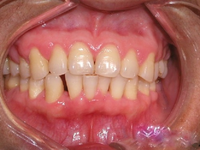 牙周炎的症状表现图片图片