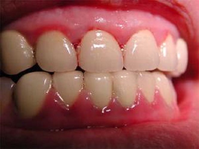 牙周炎初期症状图片图片