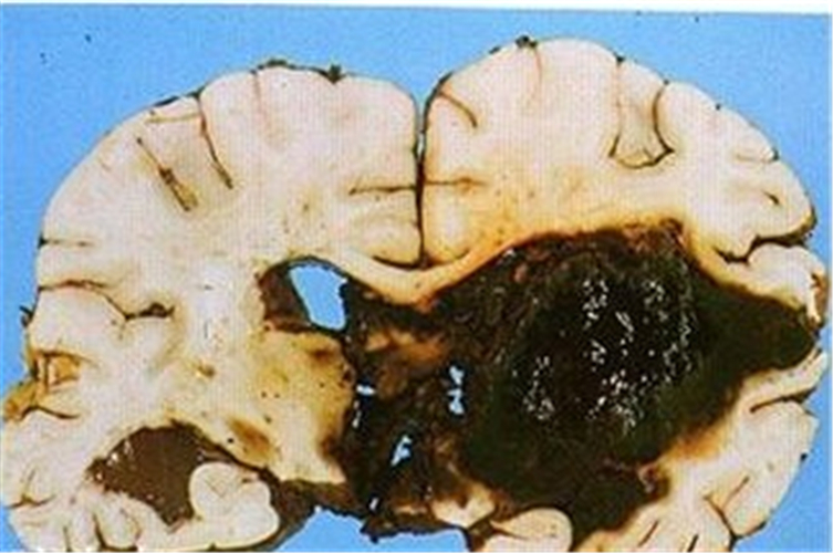 脑出血引发脑梗塞图片