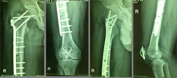 股骨近端解剖型鎖定鋼板治療股骨多處骨折