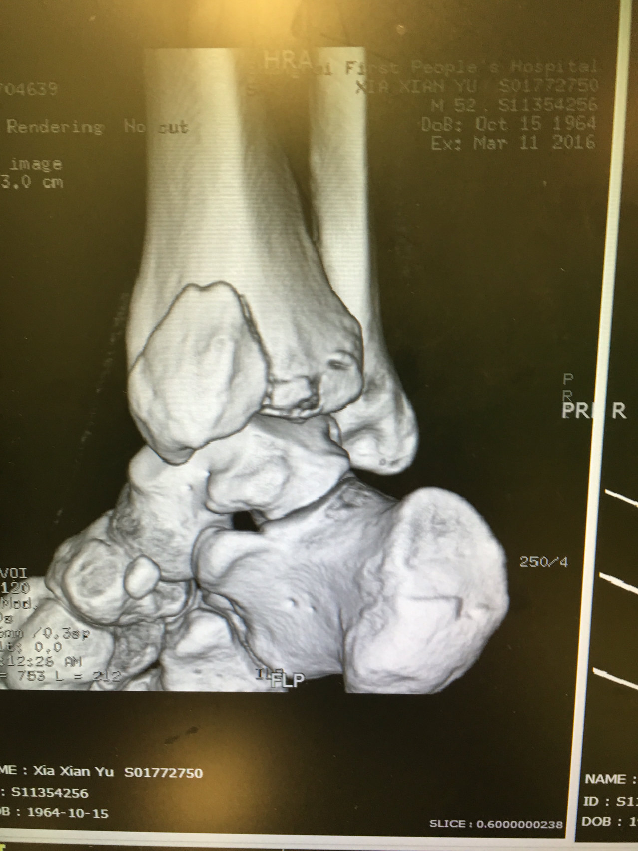 踝关节骨折x光片图片