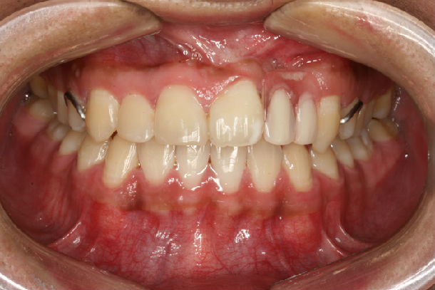 唇腭裂患者正畸治疗效果