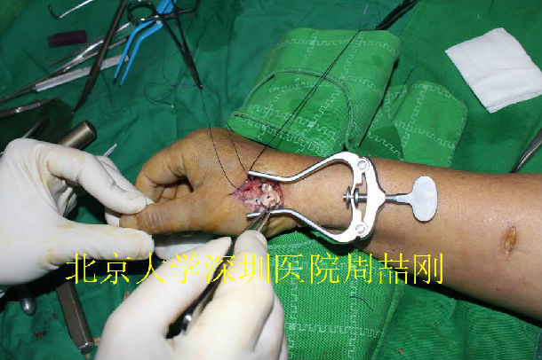 第一腕掌关节炎的手术治疗(附手术过程图片)