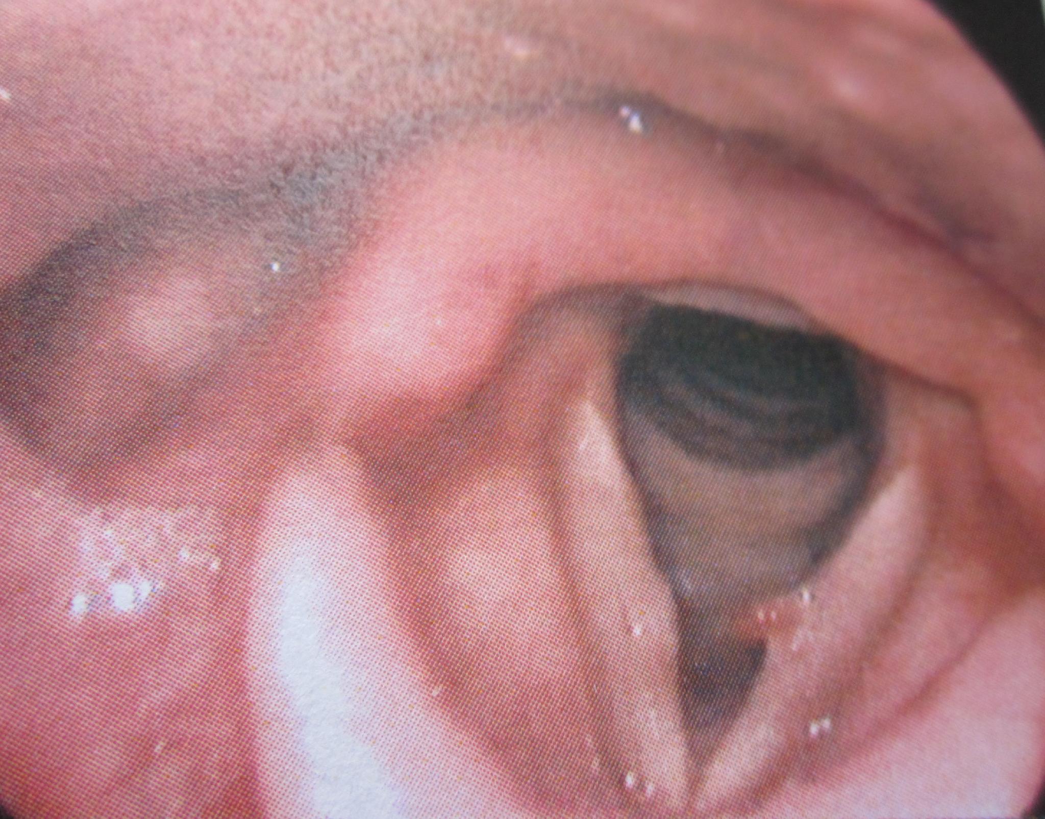 咽喉结节的症状图片图片