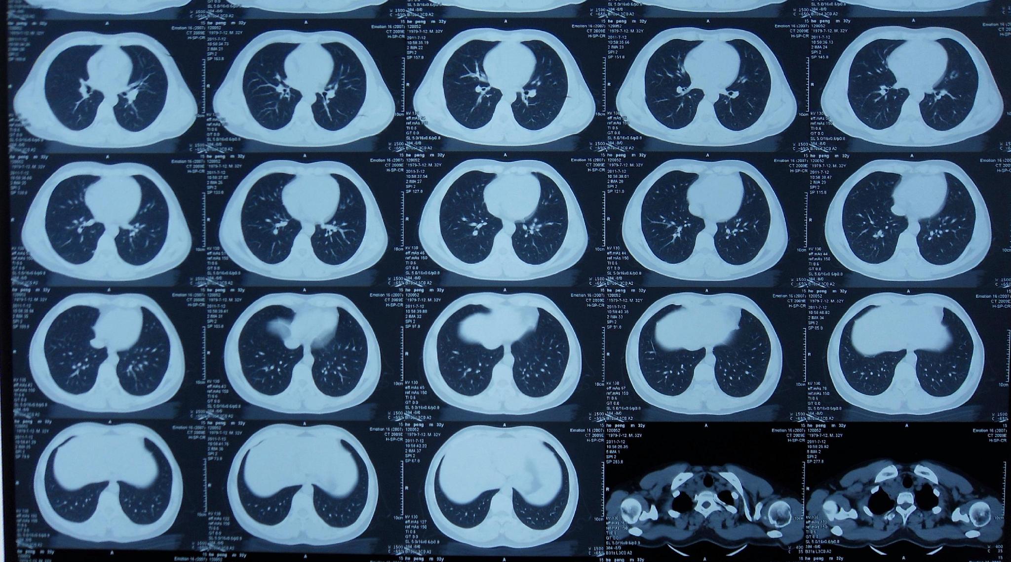 正常肺CT图片与病变CT图片