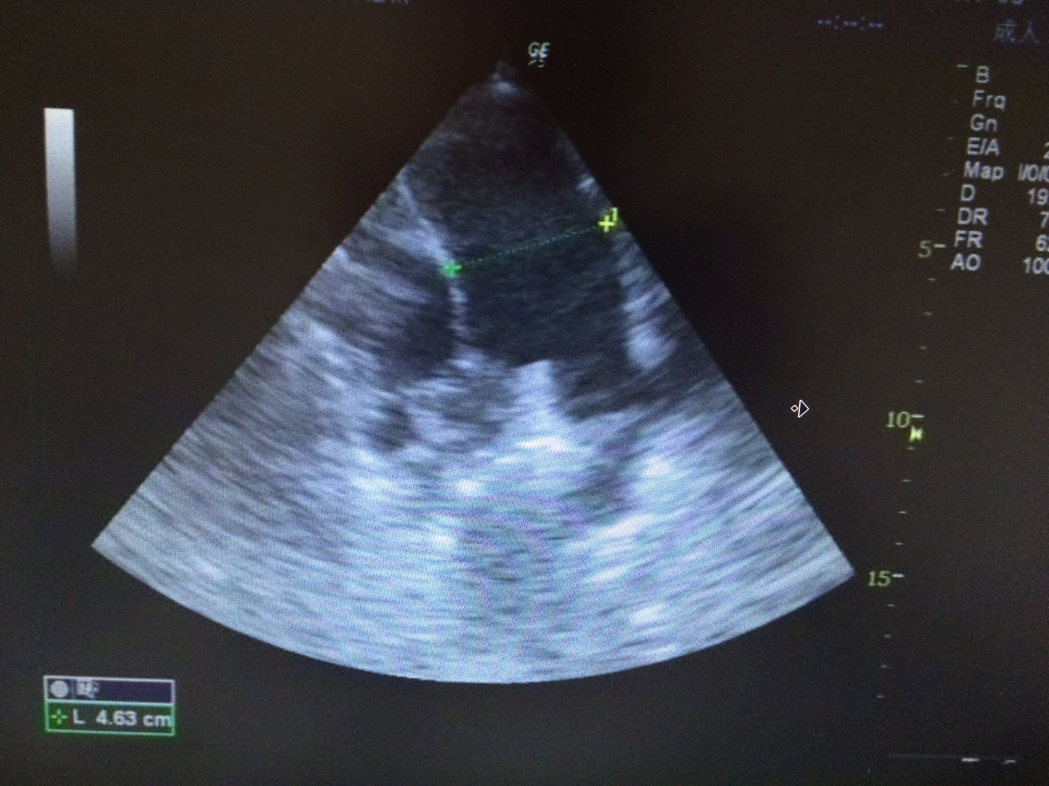 肺纤维化彩超图像图片