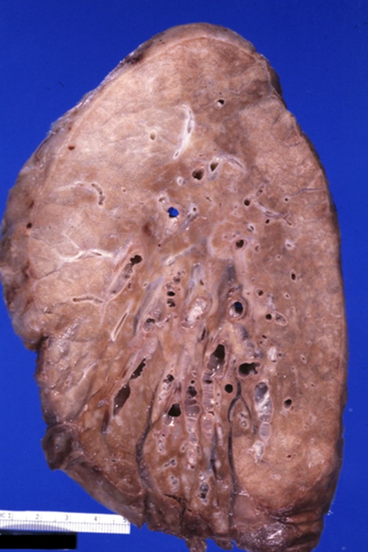 晚期肺纤维化死前症状图片