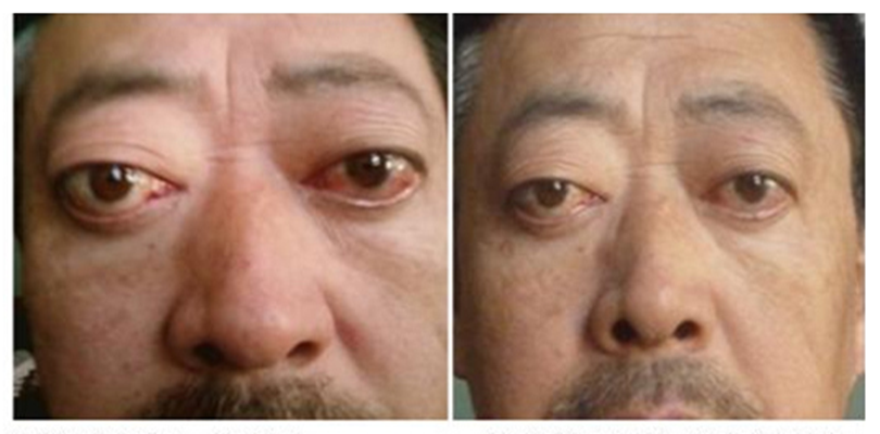 甲亢图片_甲亢症状表现图片大全_有来医生