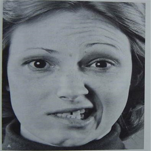 面部神经炎的图片