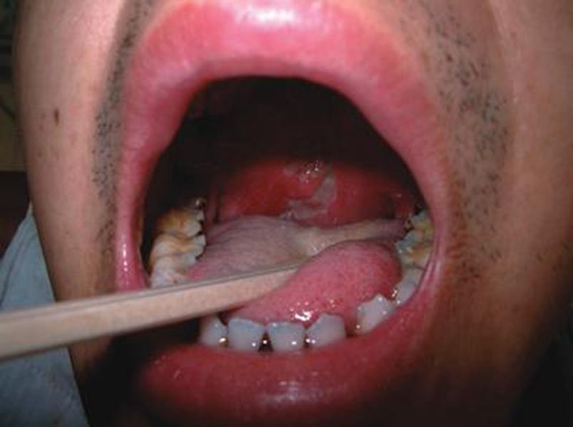 口腔淋巴的癌严重图片