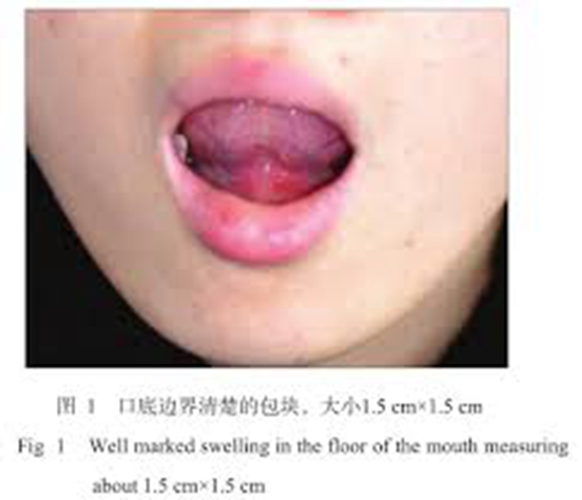 舌下腺囊肿鄂下图片   舌下腺囊肿和淋巴肿大图片