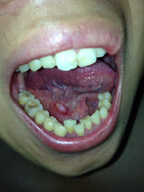 舌下腺红肿图片