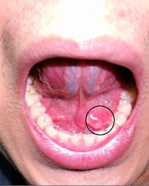 舌下腺开口图片