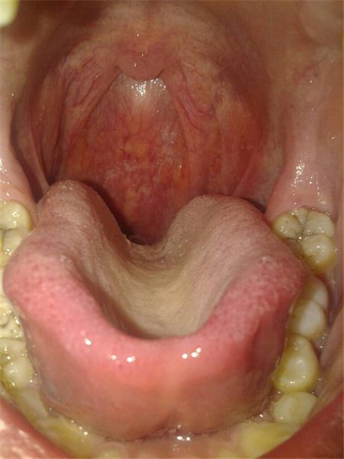 声带小结口腔早期症状图片