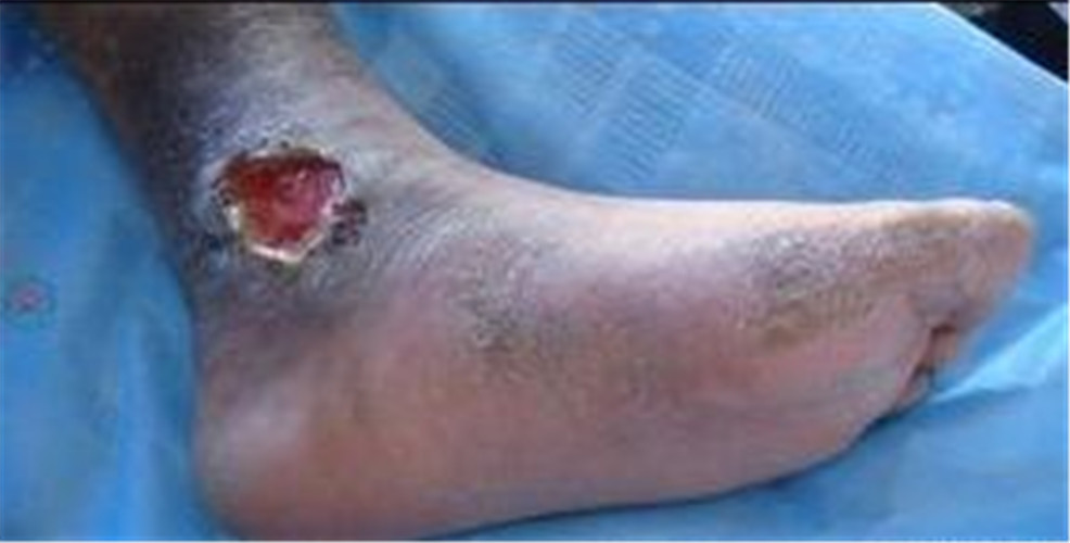 白塞病烂脚图片