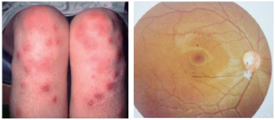 白塞氏病图片_白塞氏病症状表现图片大全_有来医生