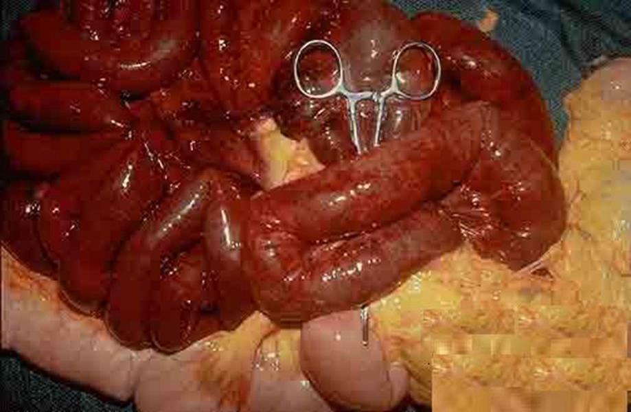 肠镜下的直肠肿瘤图片