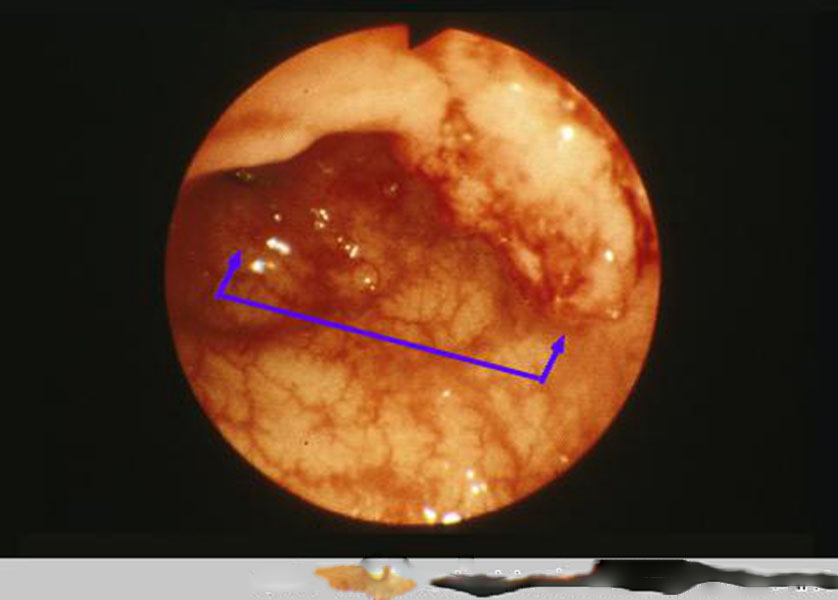 肠镜下肠癌图片图片
